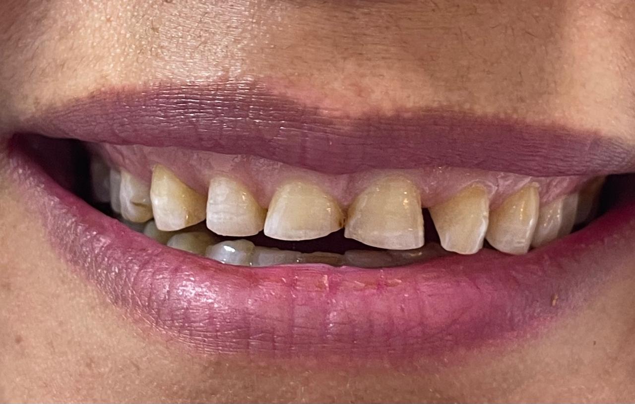 Case 05 before dental treatment