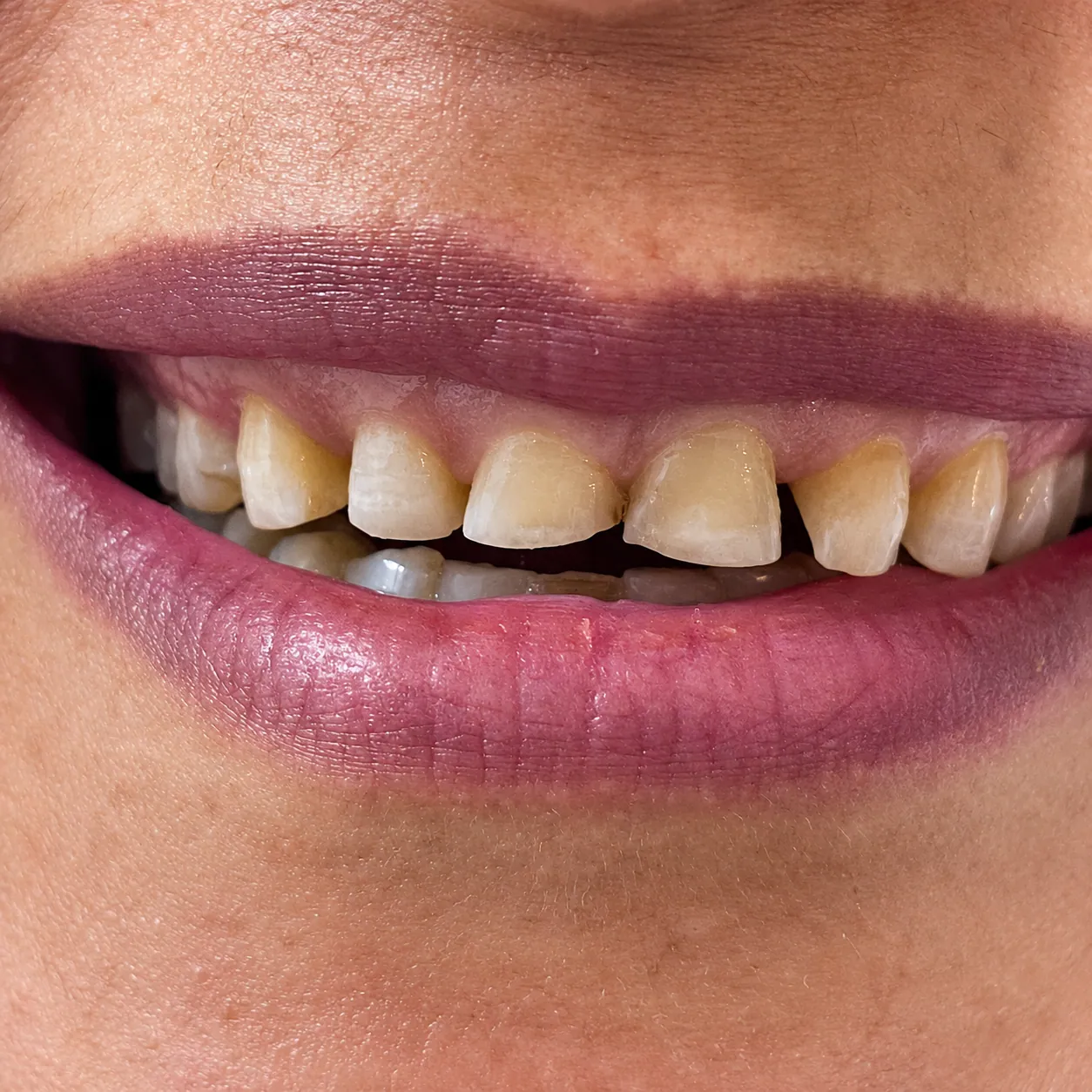 Case 04 before dental treatment