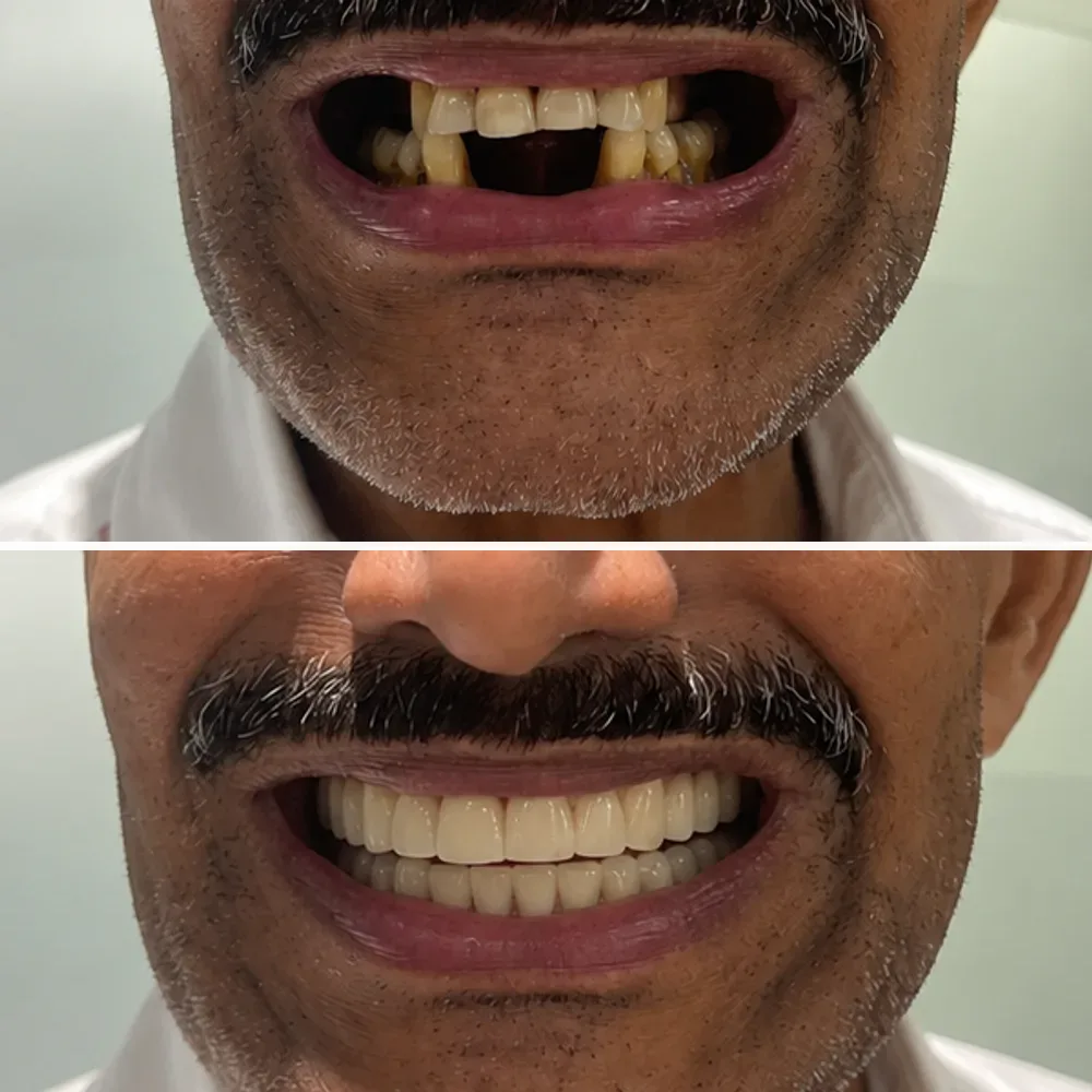 Case 11 before and after dental treatment